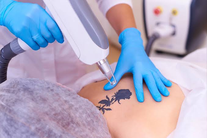 Tattoo Removal