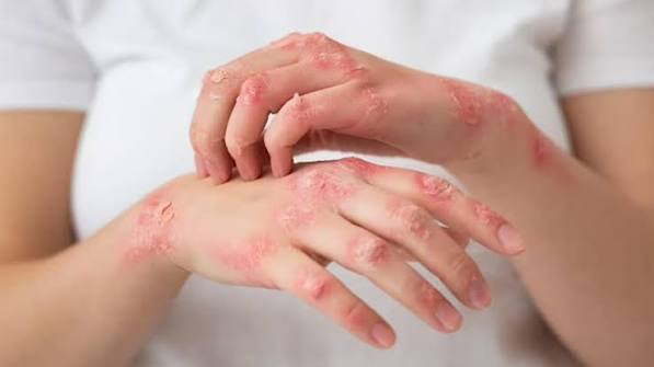 Herpes Treatment