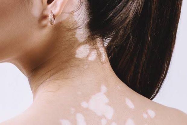 Leucoderma Treatment