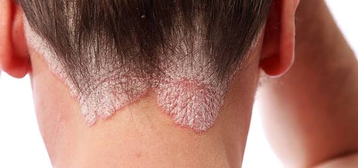 Psoriasis Treatment