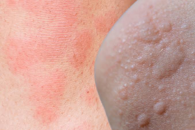 Hives Treatment