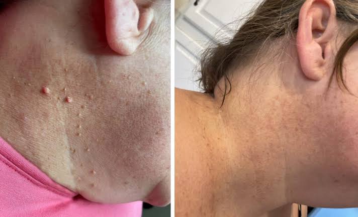 Skin Tag Removal