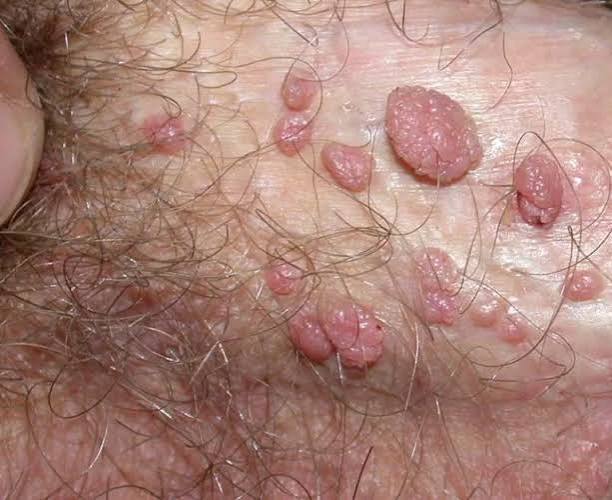 Genital Warts Treatment
