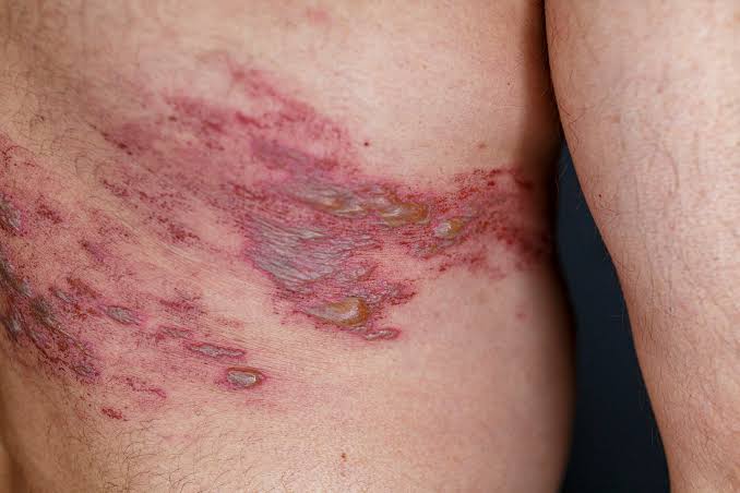 Varicella Zoster
