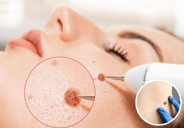 Mole and Wart Removal