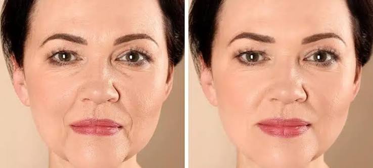 Skin Tightening