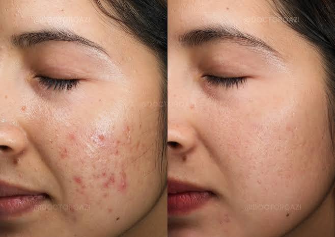 Acne Treatment