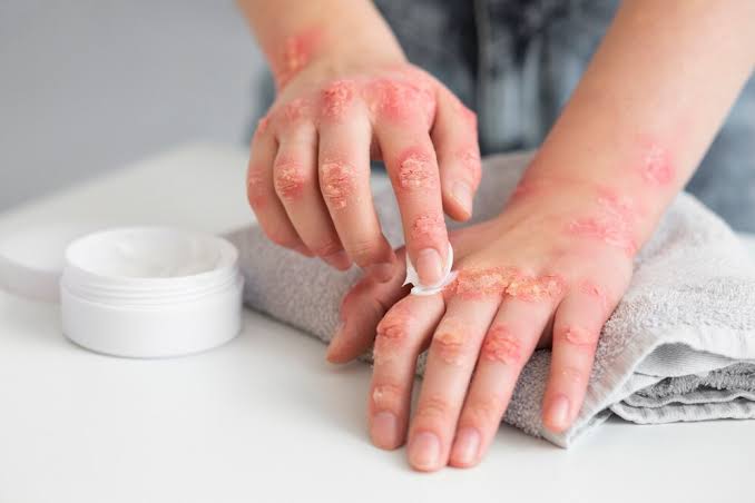 Fungal Treatment